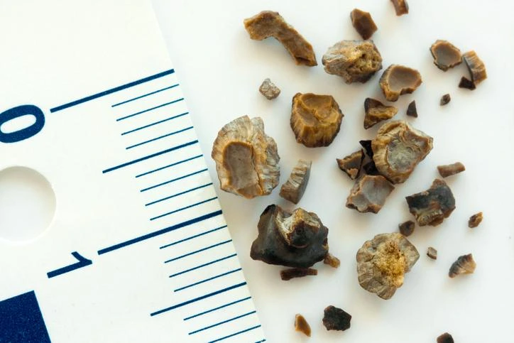 Calcolosi urinaria — Trattamento conservativo e chirurgico dei calcoli renali e ureterali.